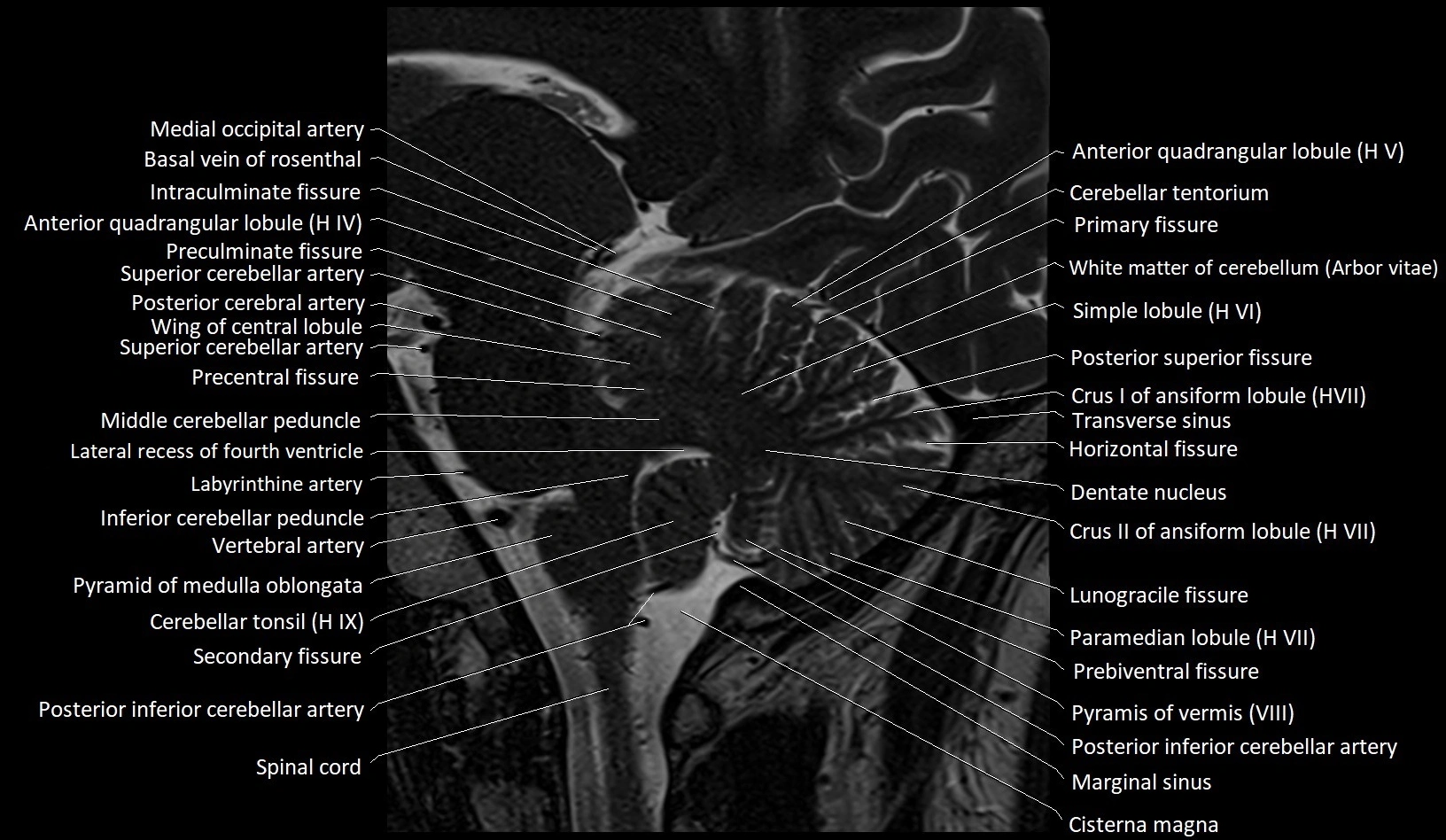 MRI Cerebellar anatomy sagittal High-resolution labelled image 25.webp